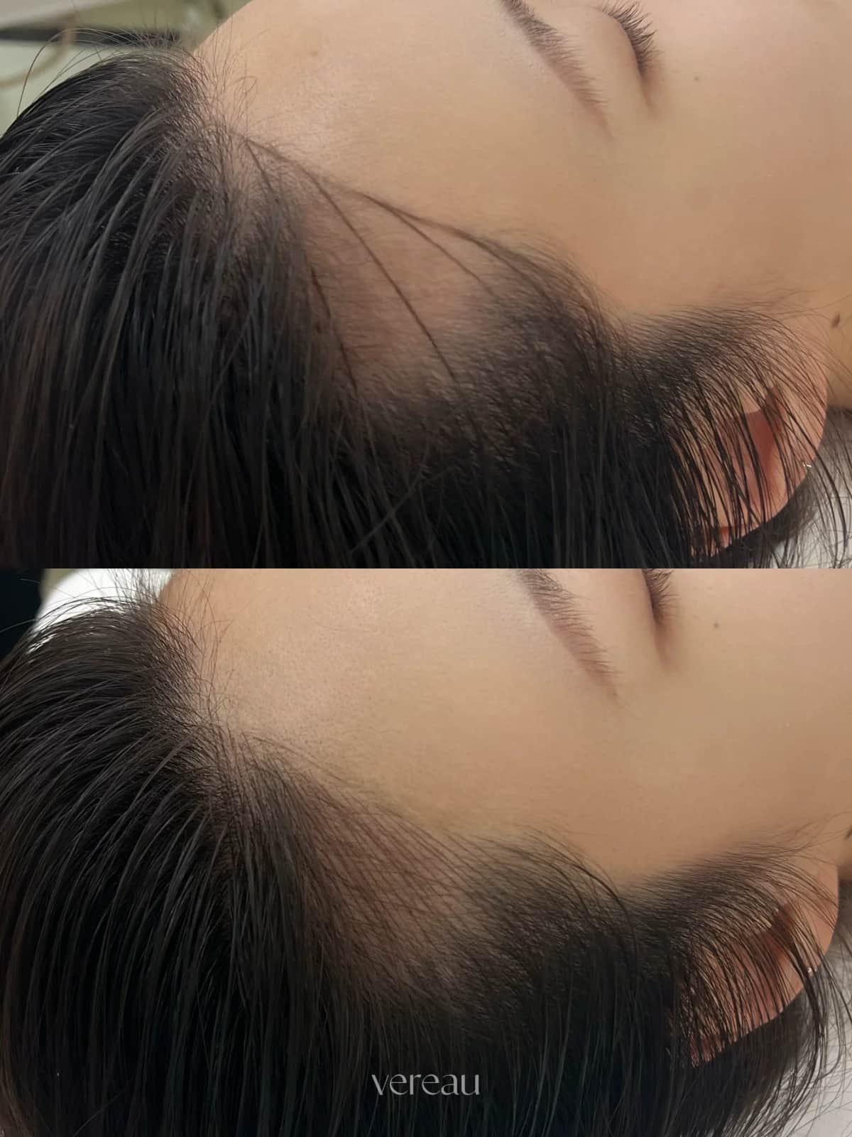 잔머리 내추럴 헤어라인