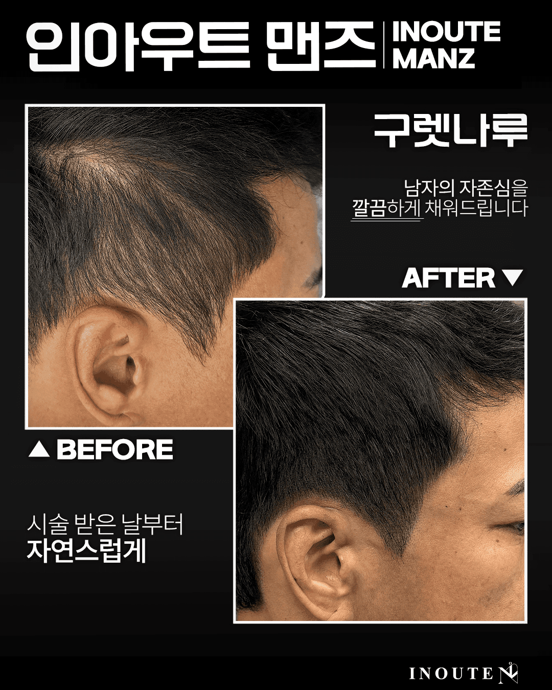 남자 사이드/구렛나루 밀도보강(3회)