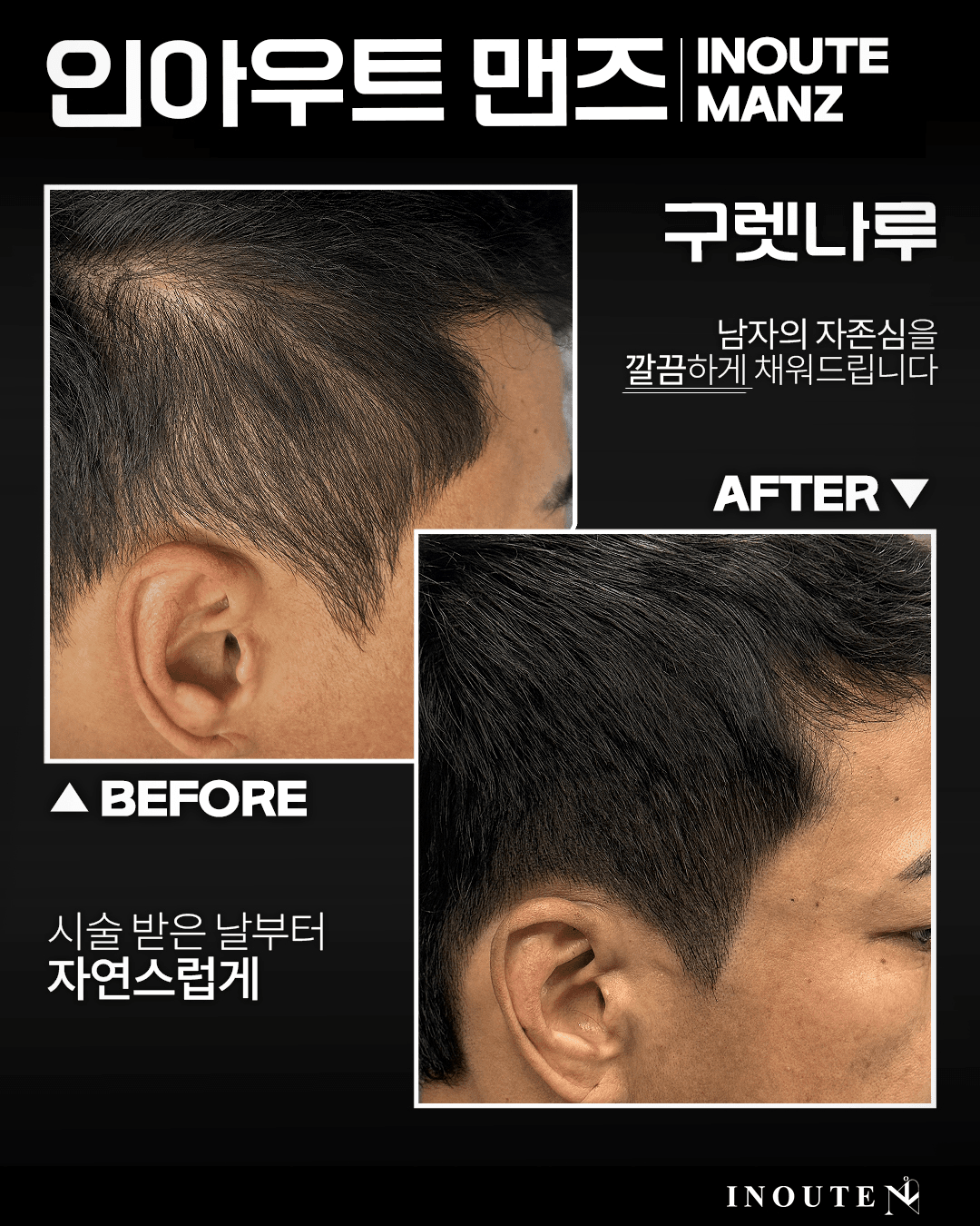 남자 사이드/구렛나루 밀도보강(3회)