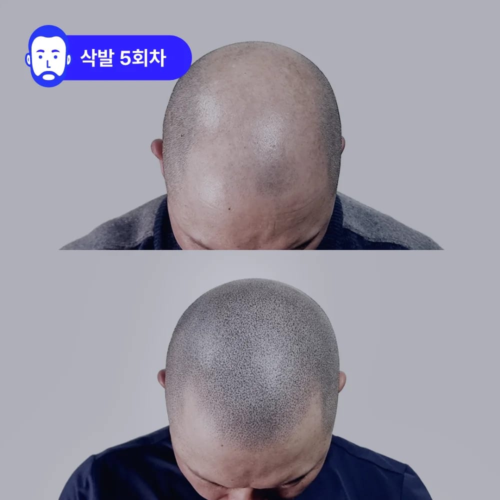 삭발 SMP 5회차 | 자연스러운 두피 밀도 개선