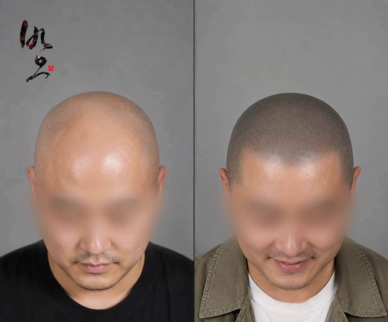 삭발 SMP | 자연스러운 두피 밀도 표현