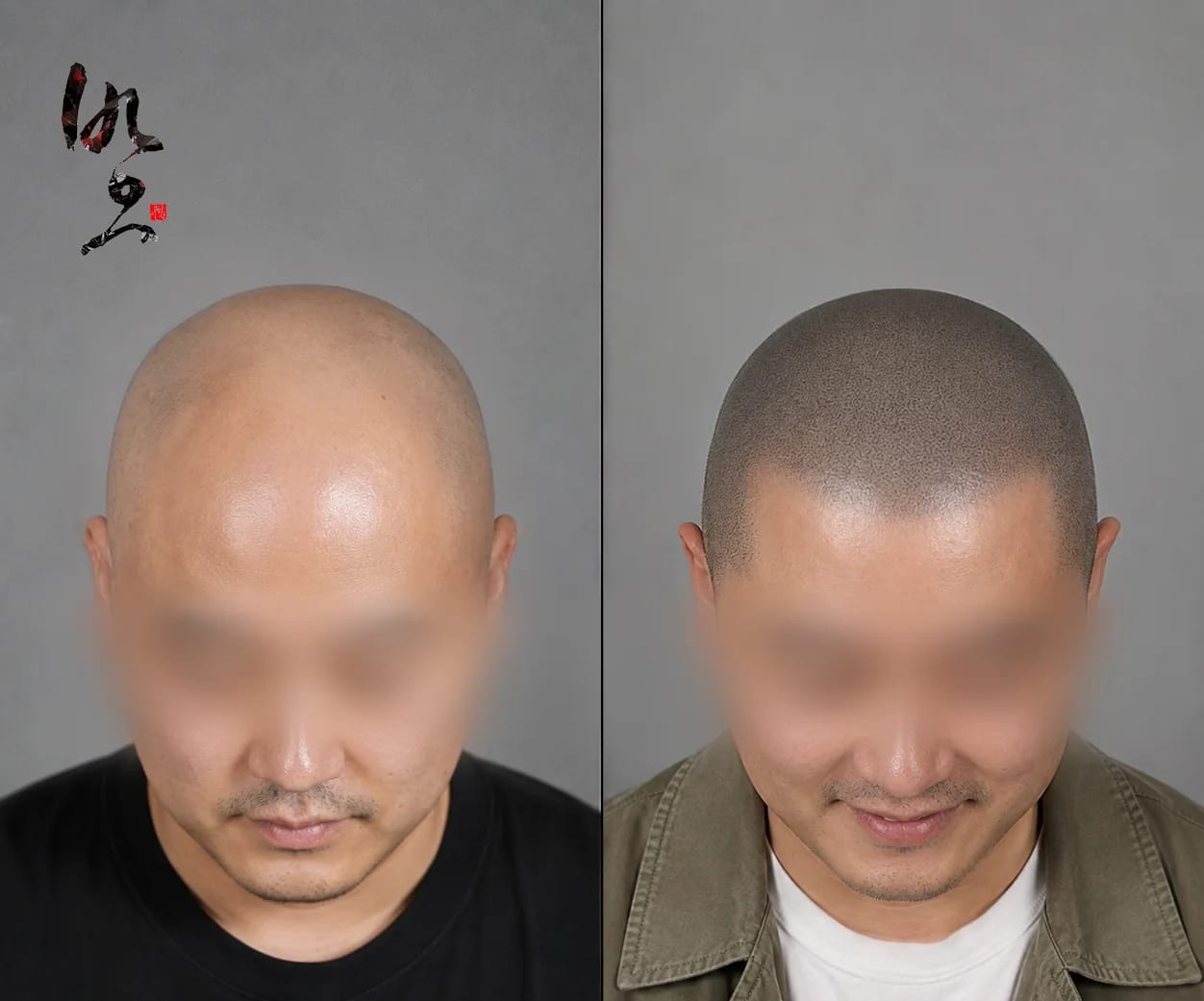 삭발 SMP | 자연스러운 두피 밀도 표현