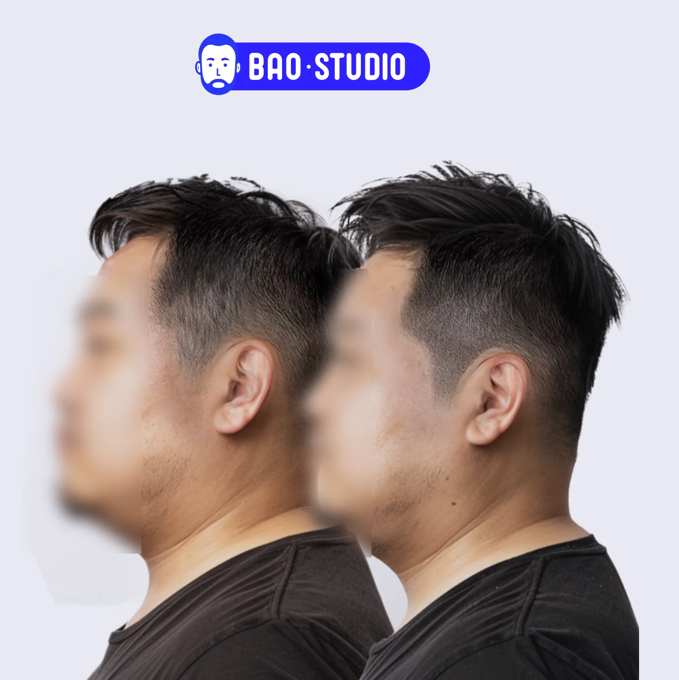 옆머리 밀도 보강 SMP | 자연스러운 사이드 커버