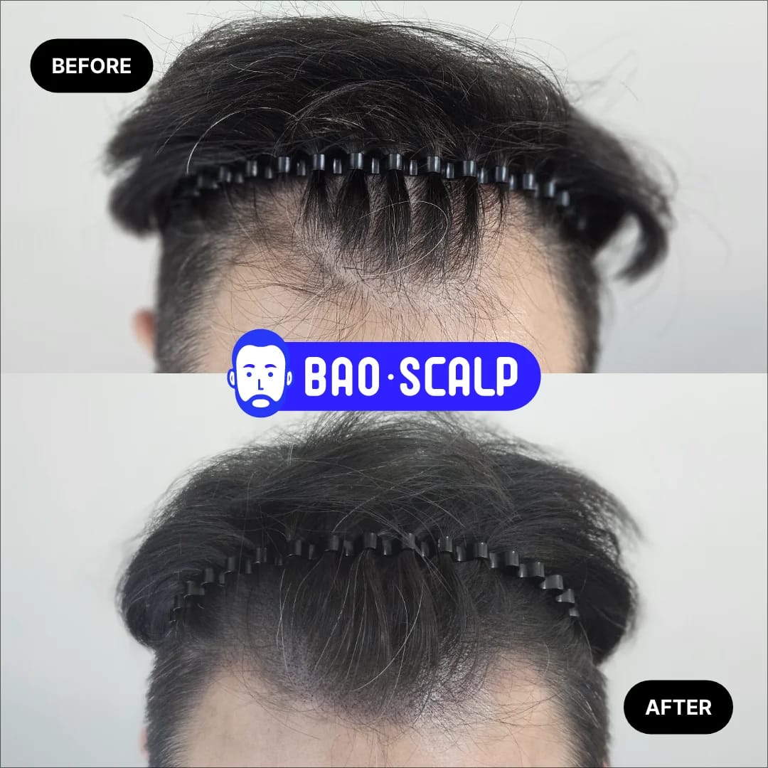 남성 헤어라인 SMP | M자 헤어라인 밀도 보강