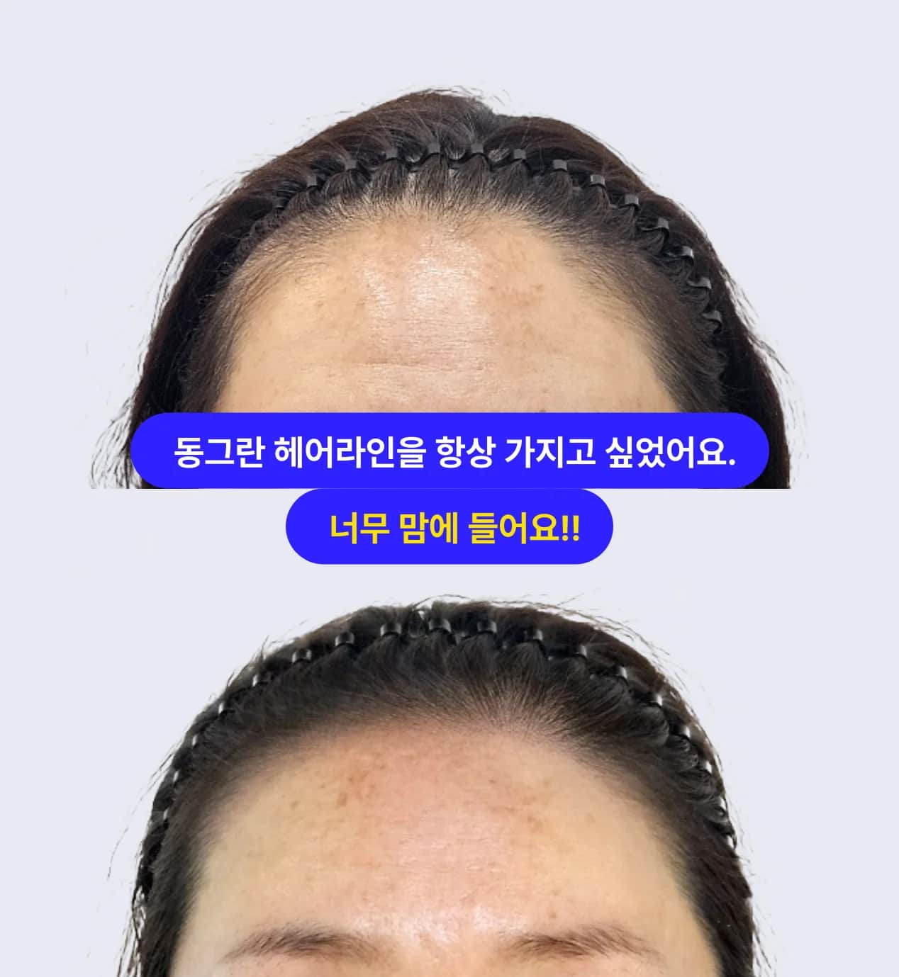 여성 헤어라인 SMP | 둥근 헤어라인 완성
