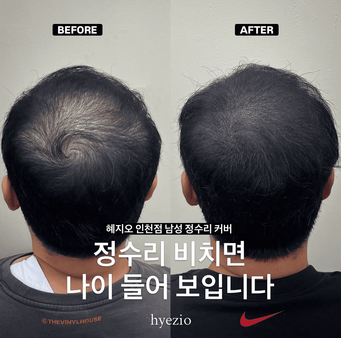 남성 정수리 두피문신 SMP
