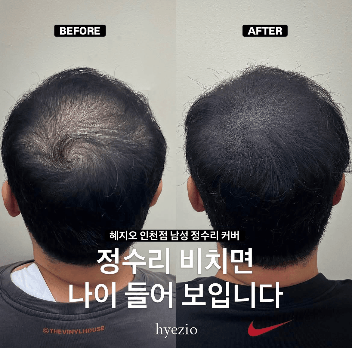 남성 정수리 두피문신 SMP