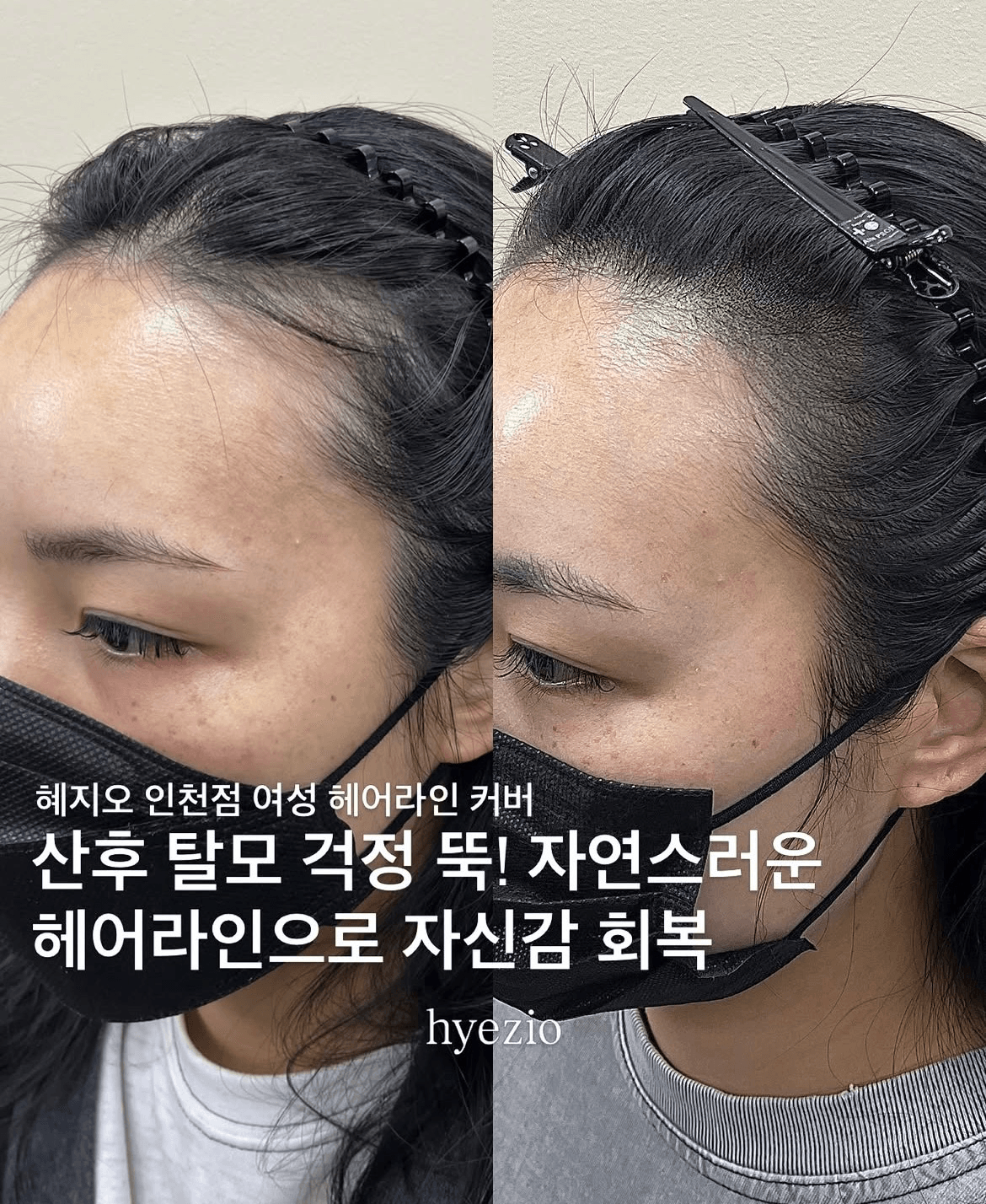 여성 헤어라인 두피문신 SMP