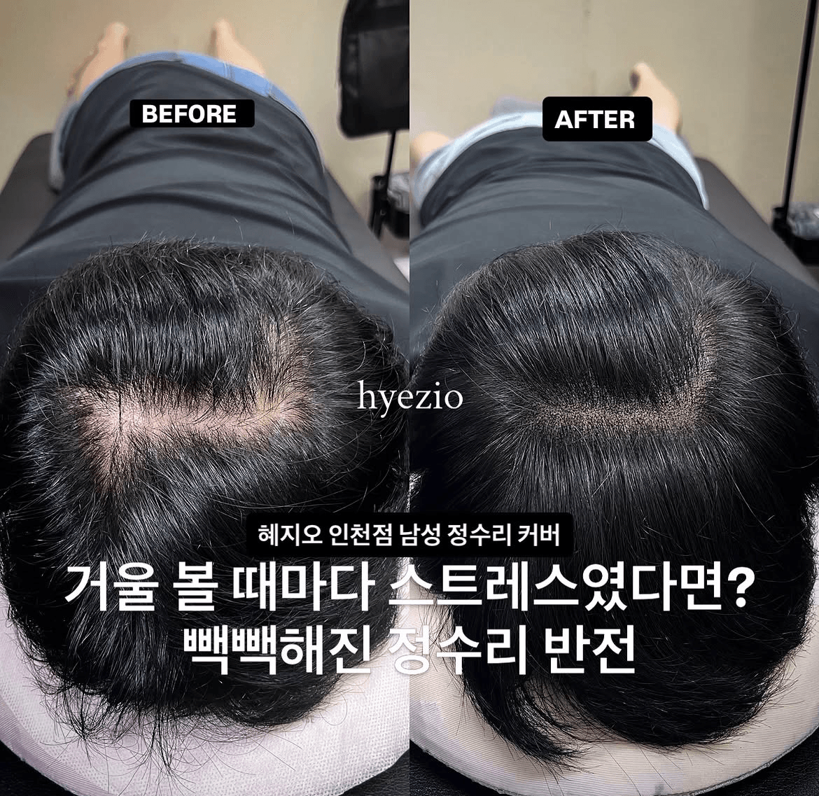 남성 정수리 두피문신