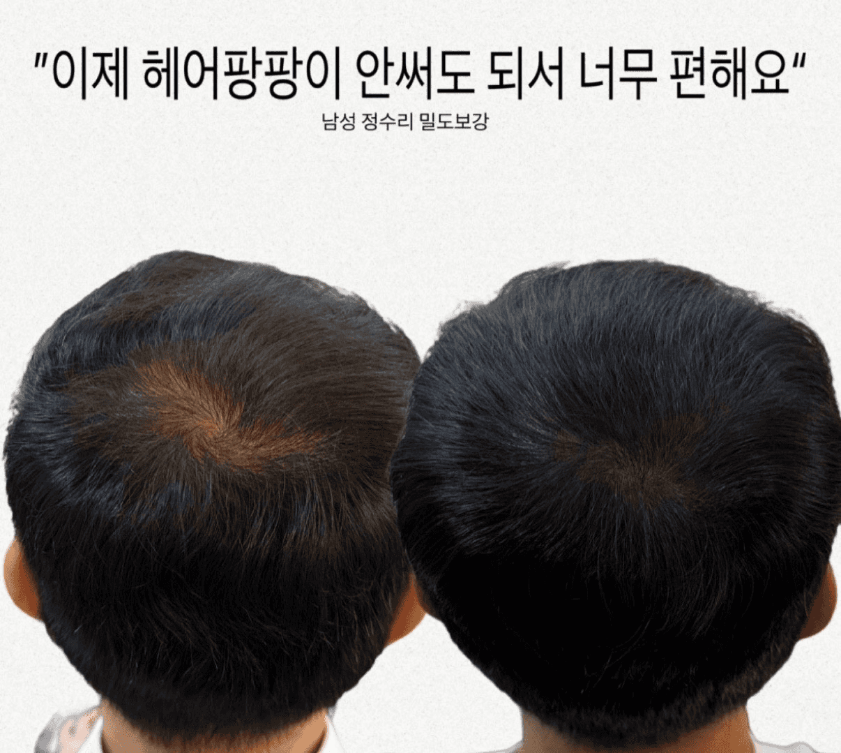 남자 정수리 숱채움