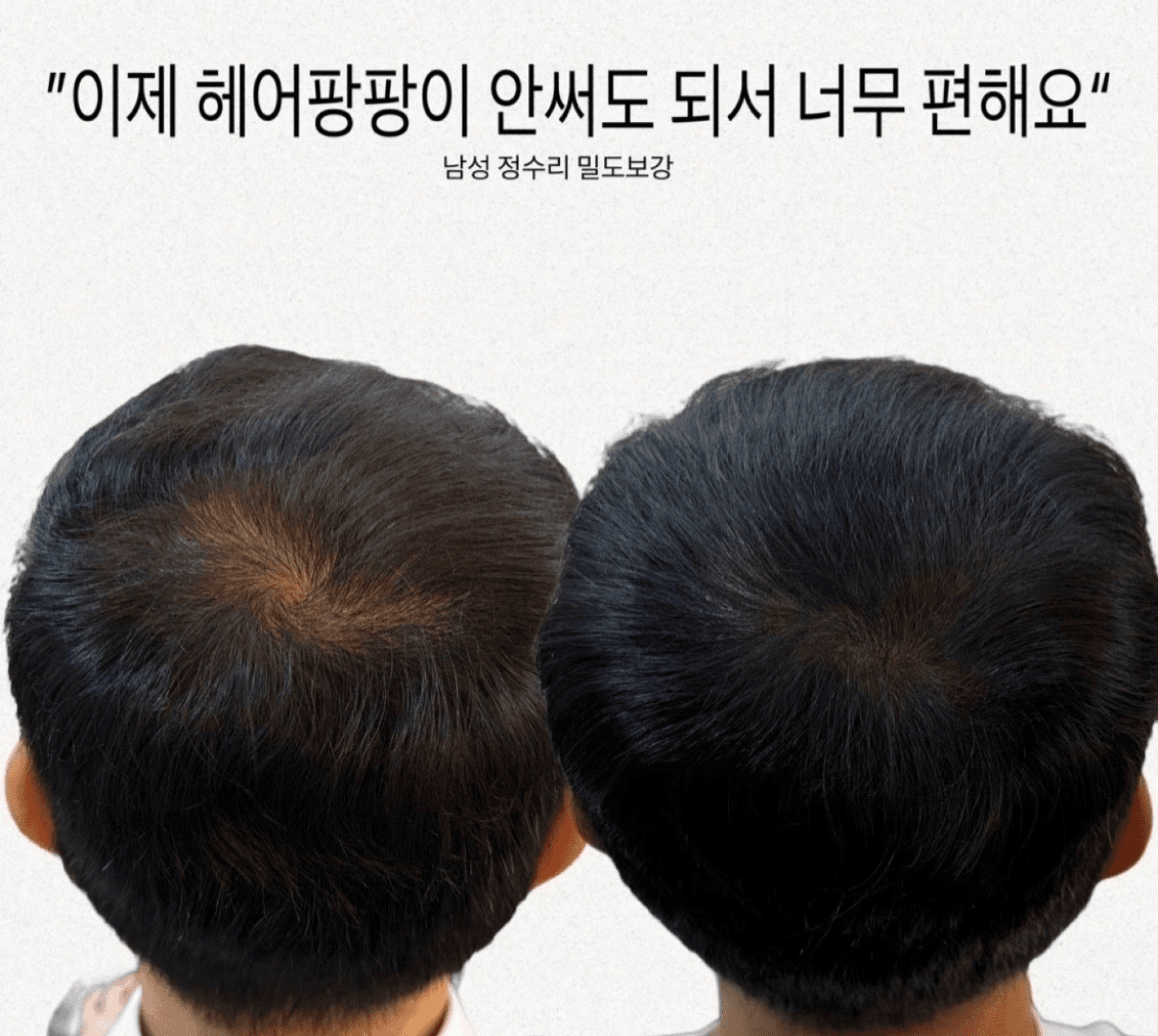남자 정수리 숱채움