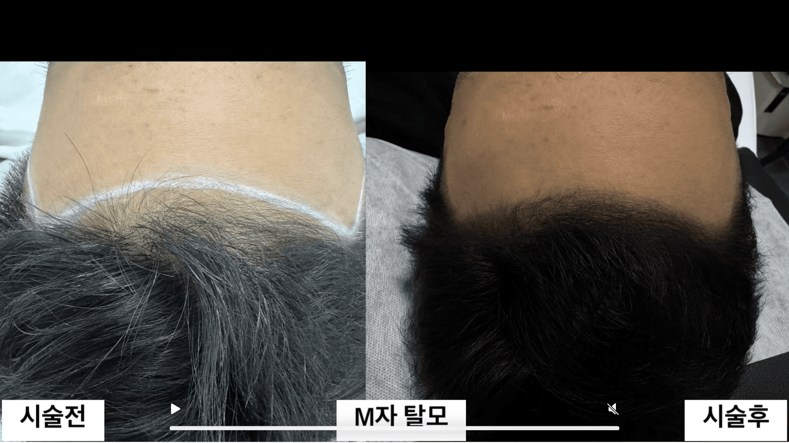 남성M자탈모