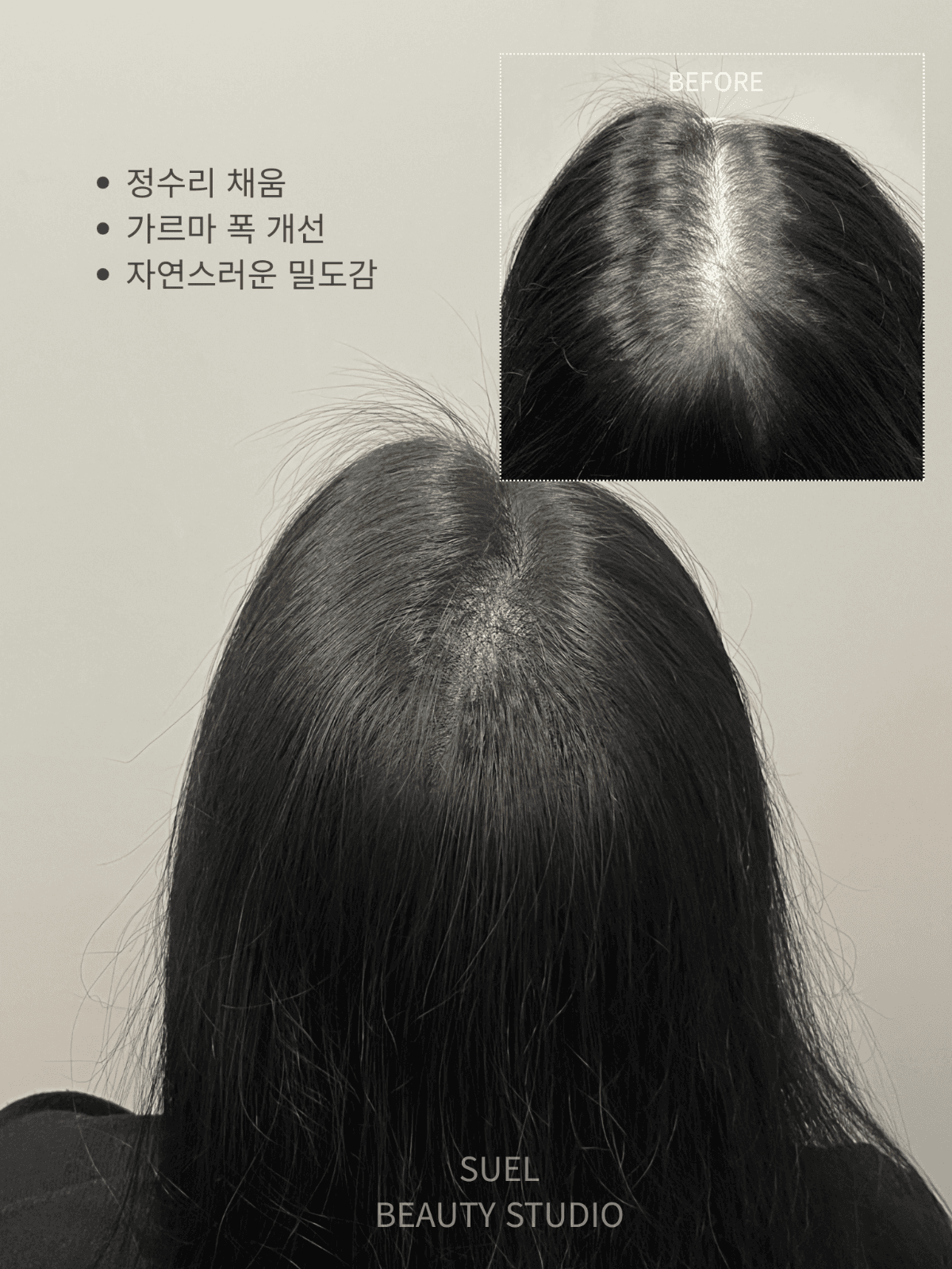 🤍SMP 두피채움|가르마 · 정수리 · 헤어라인 자연 밀도 개선🤍