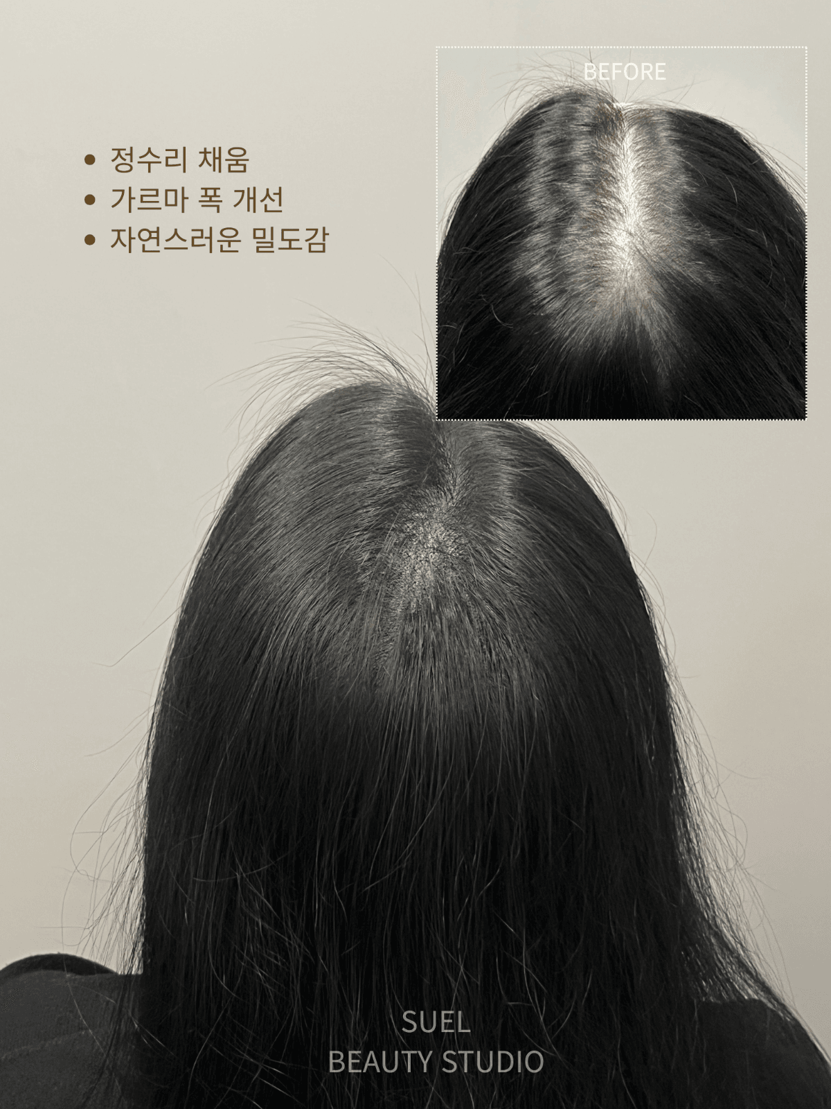 🤍SMP 두피채움|가르마 · 정수리 · 헤어라인 자연 밀도 개선🤍