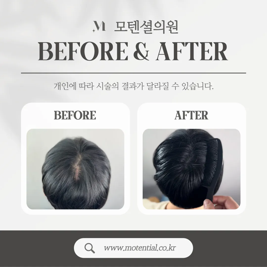 두피문신