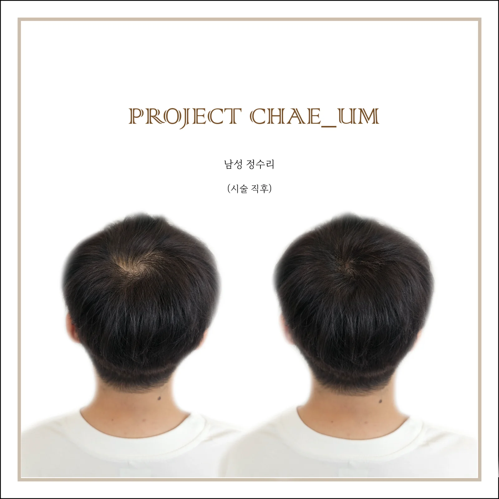 정수리/원형탈모 smp