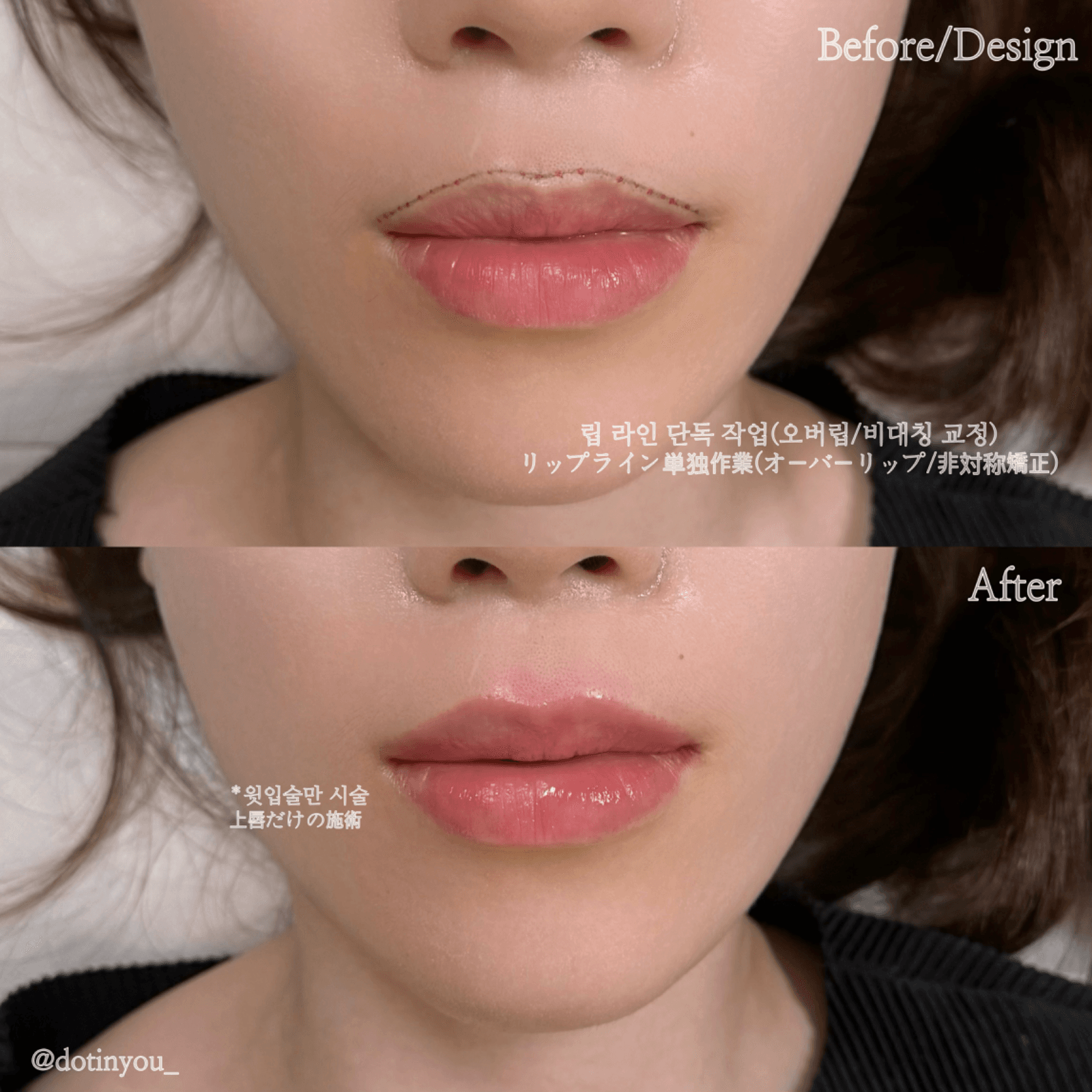 입술 립라인 단독(오버립/비대칭교정)
