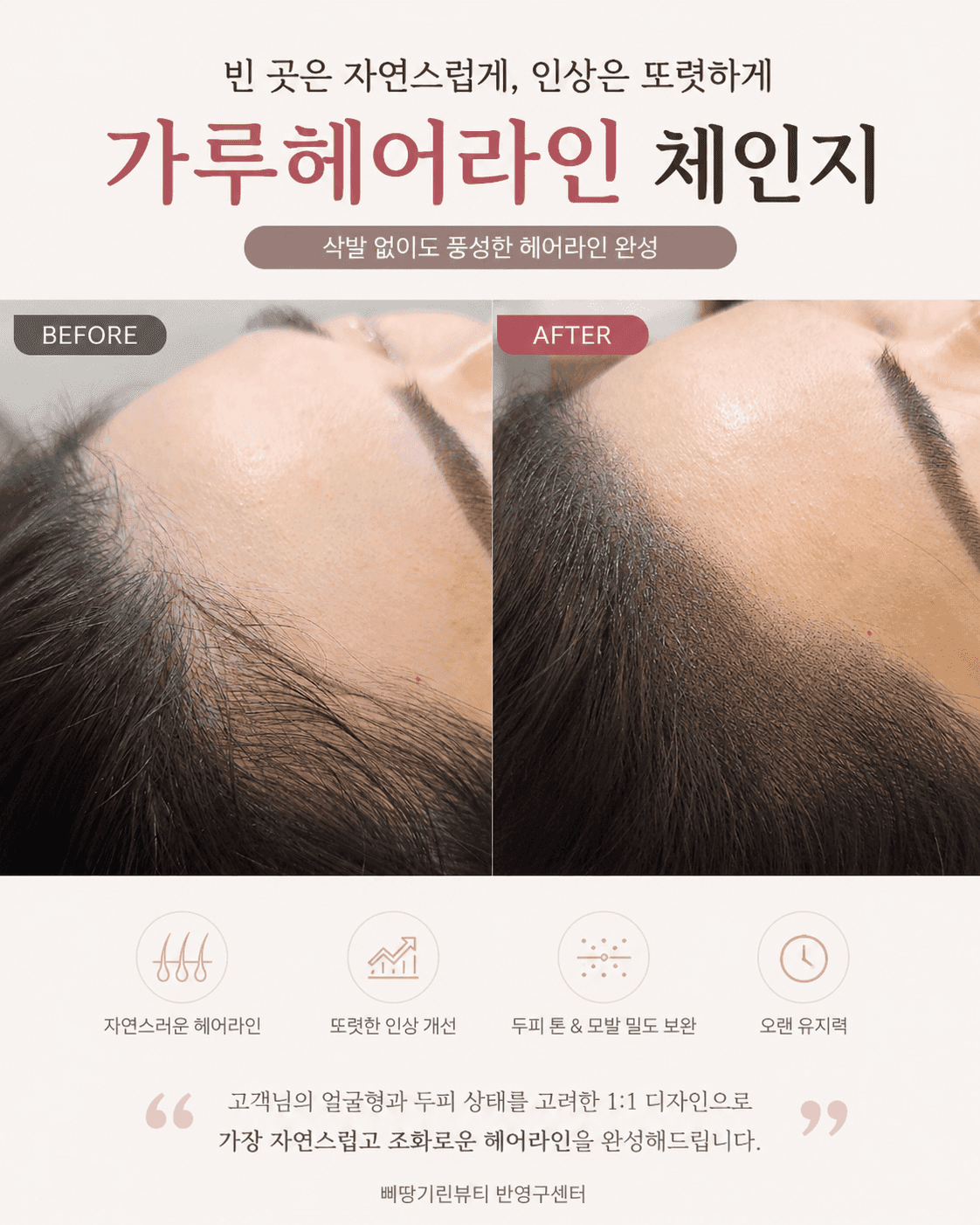 M자 가루헤어라인으로 커버 🤎