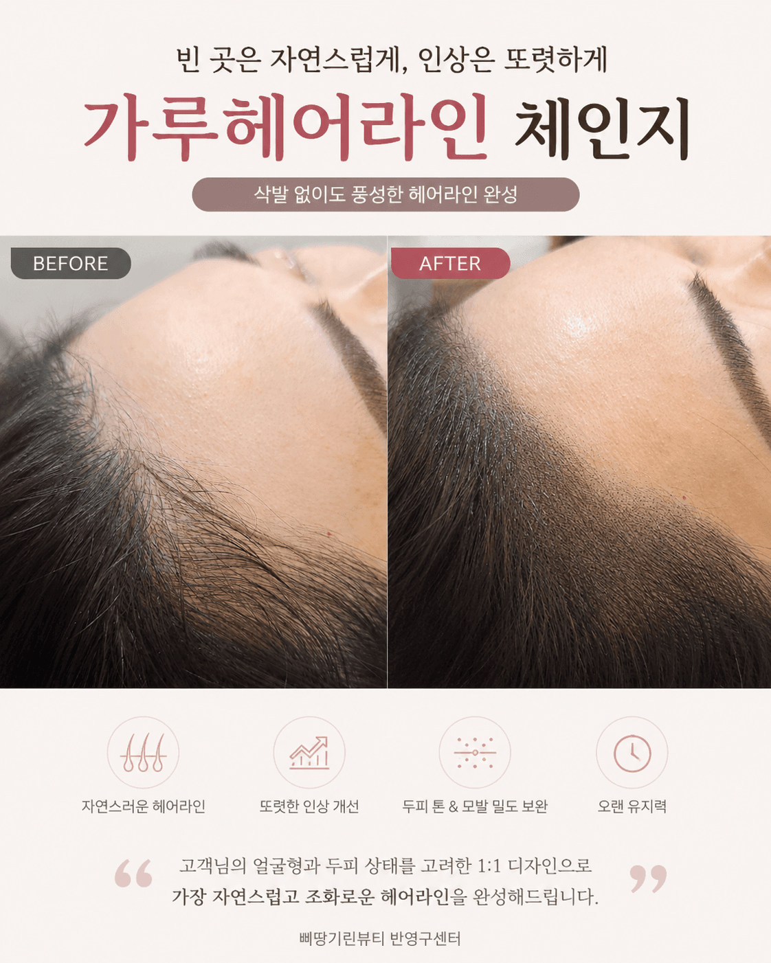 M자 가루헤어라인으로 커버 🤎