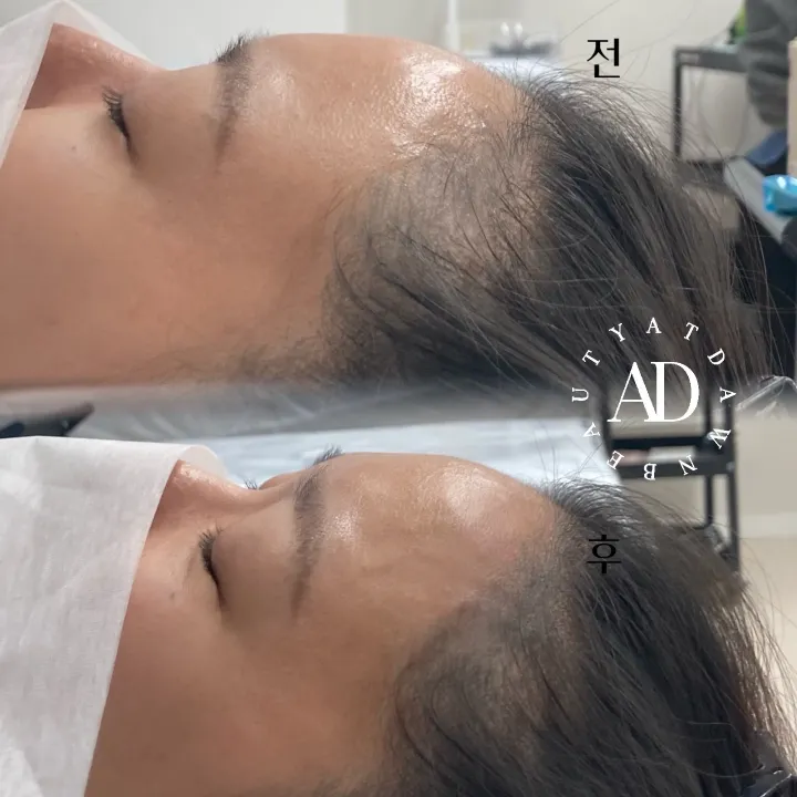 잔흔 덮어버리기
