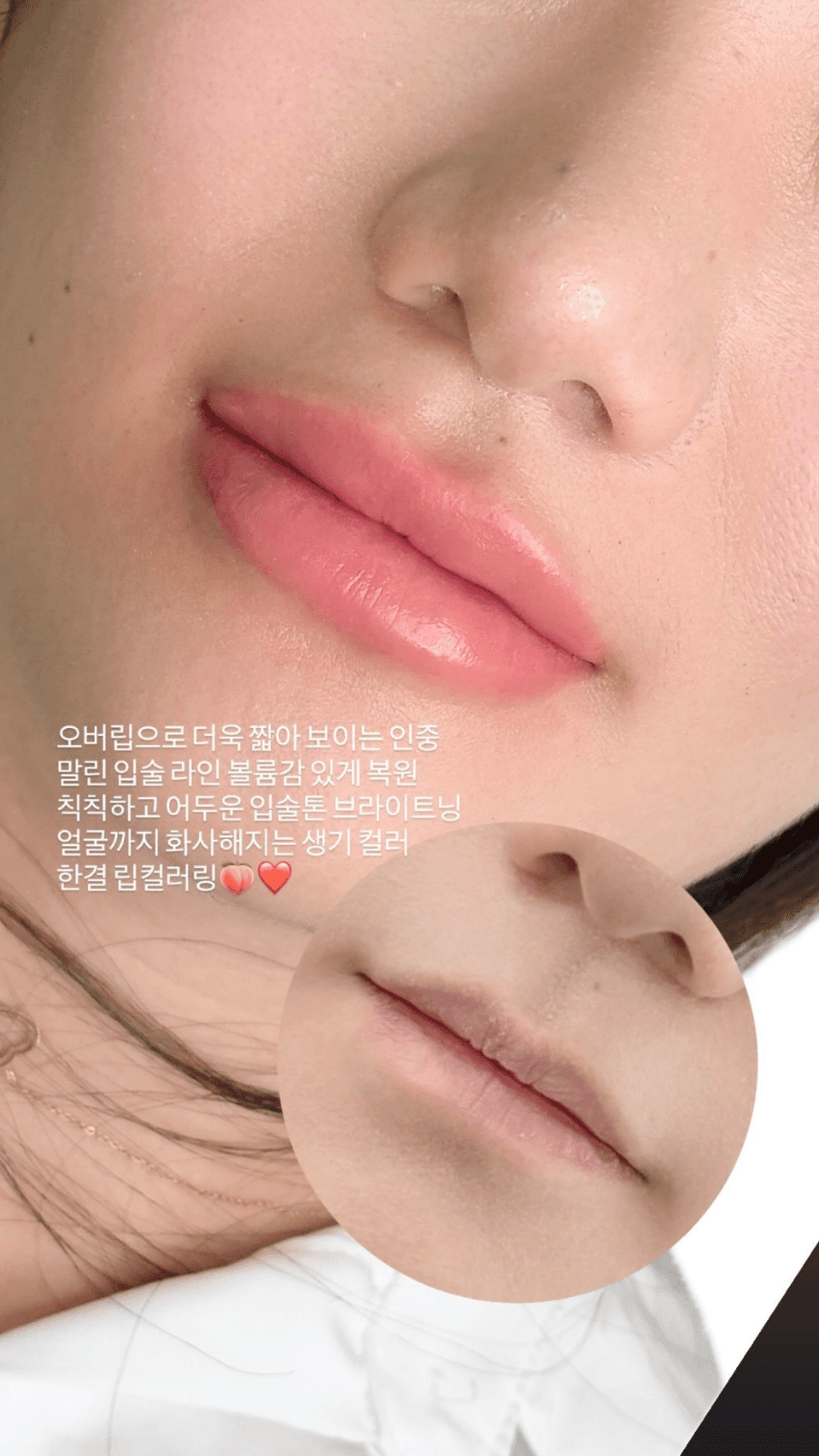 오버립으로 인중까지 교정 완료