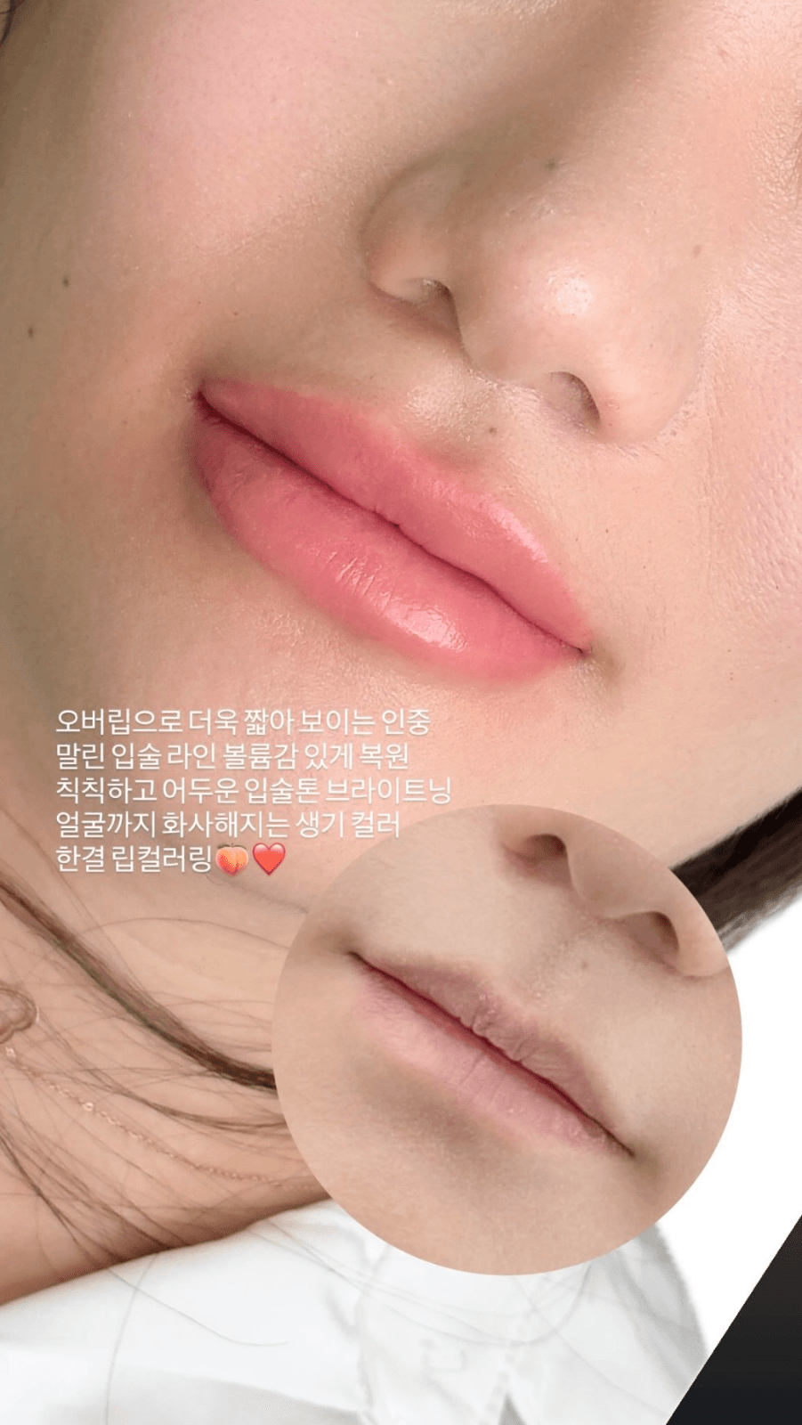 오버립으로 인중까지 교정 완료