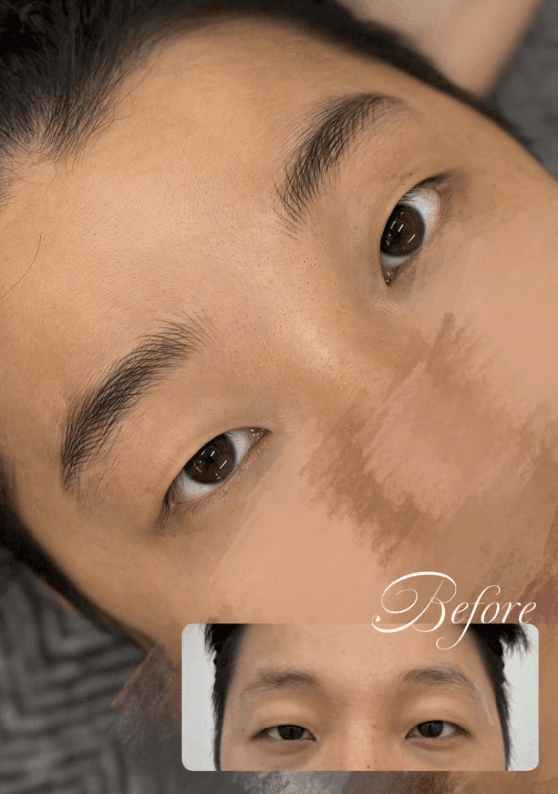 '짱구' 될까 걱정 마세요. 시술 직후부터 내 눈썹처럼