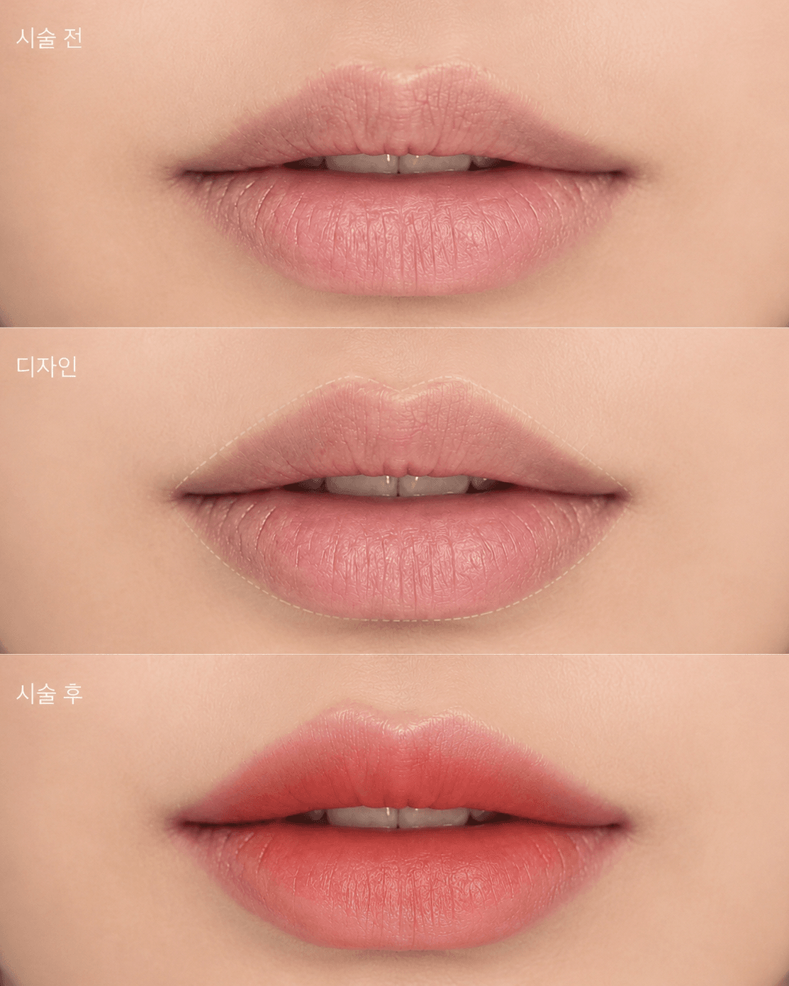 입술필러보다 립라인 재건