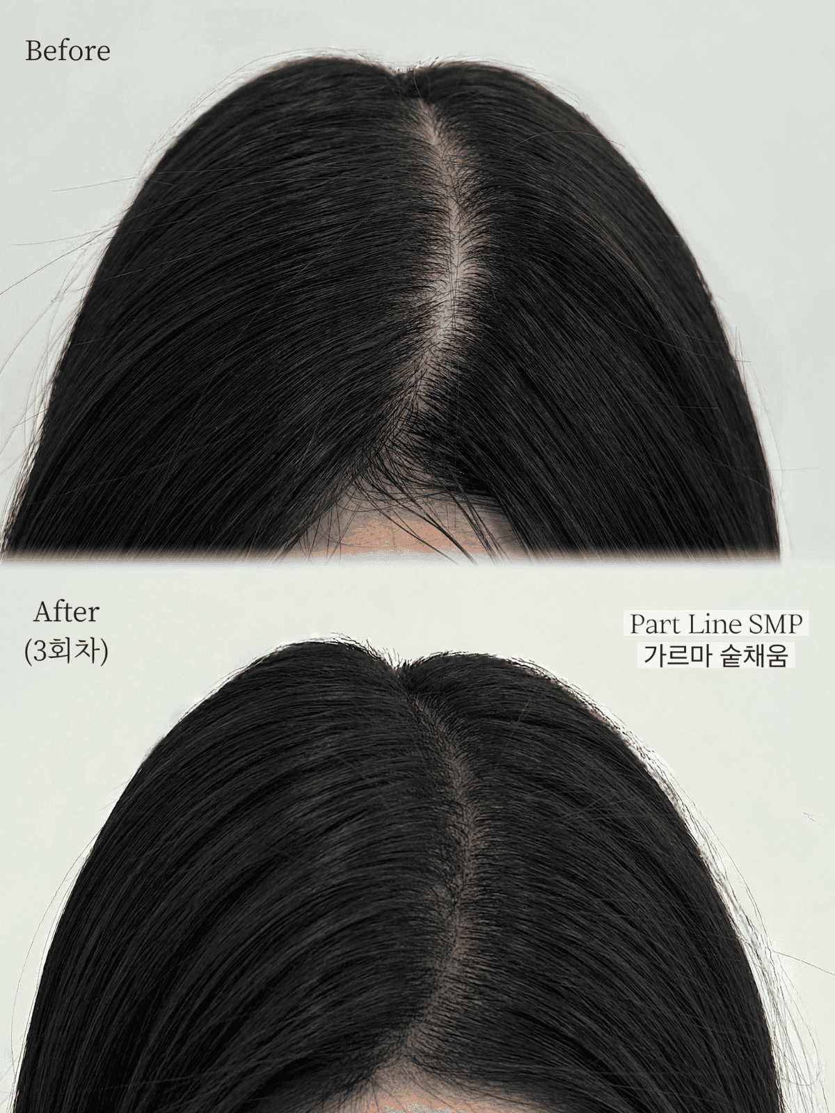 SMP(가르마+정수리) 3회