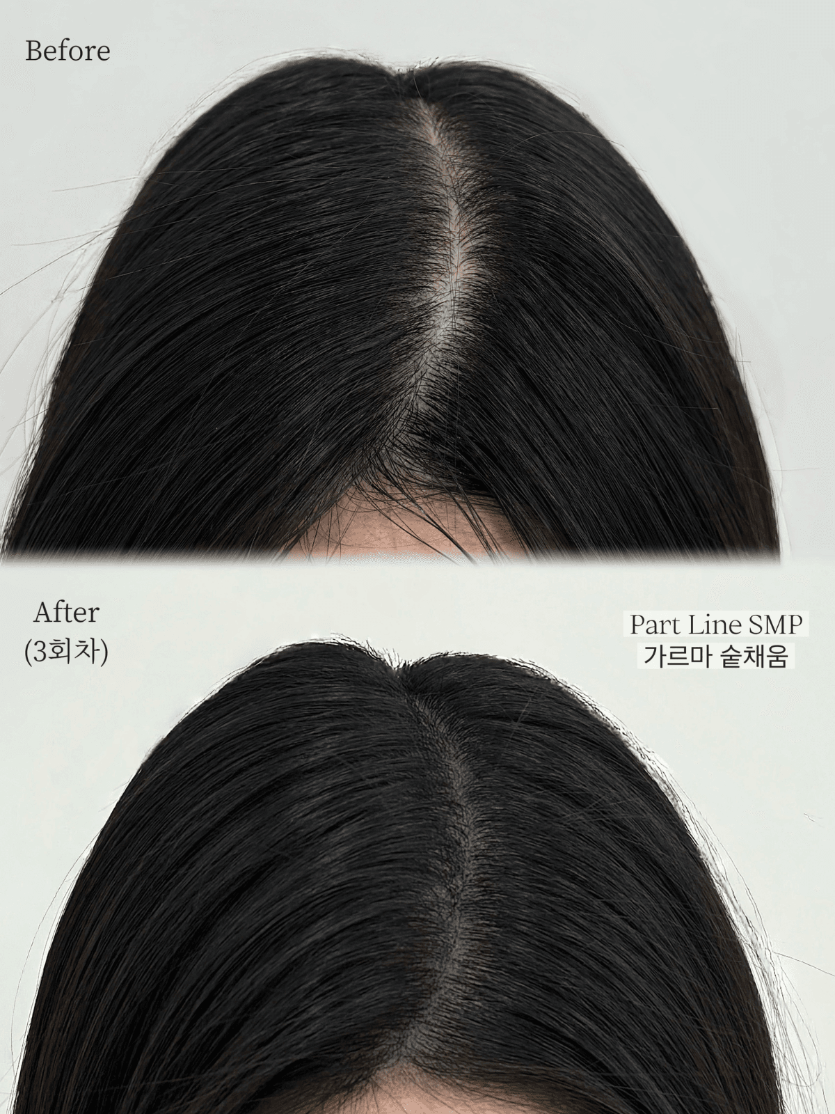 SMP(가르마+정수리) 3회