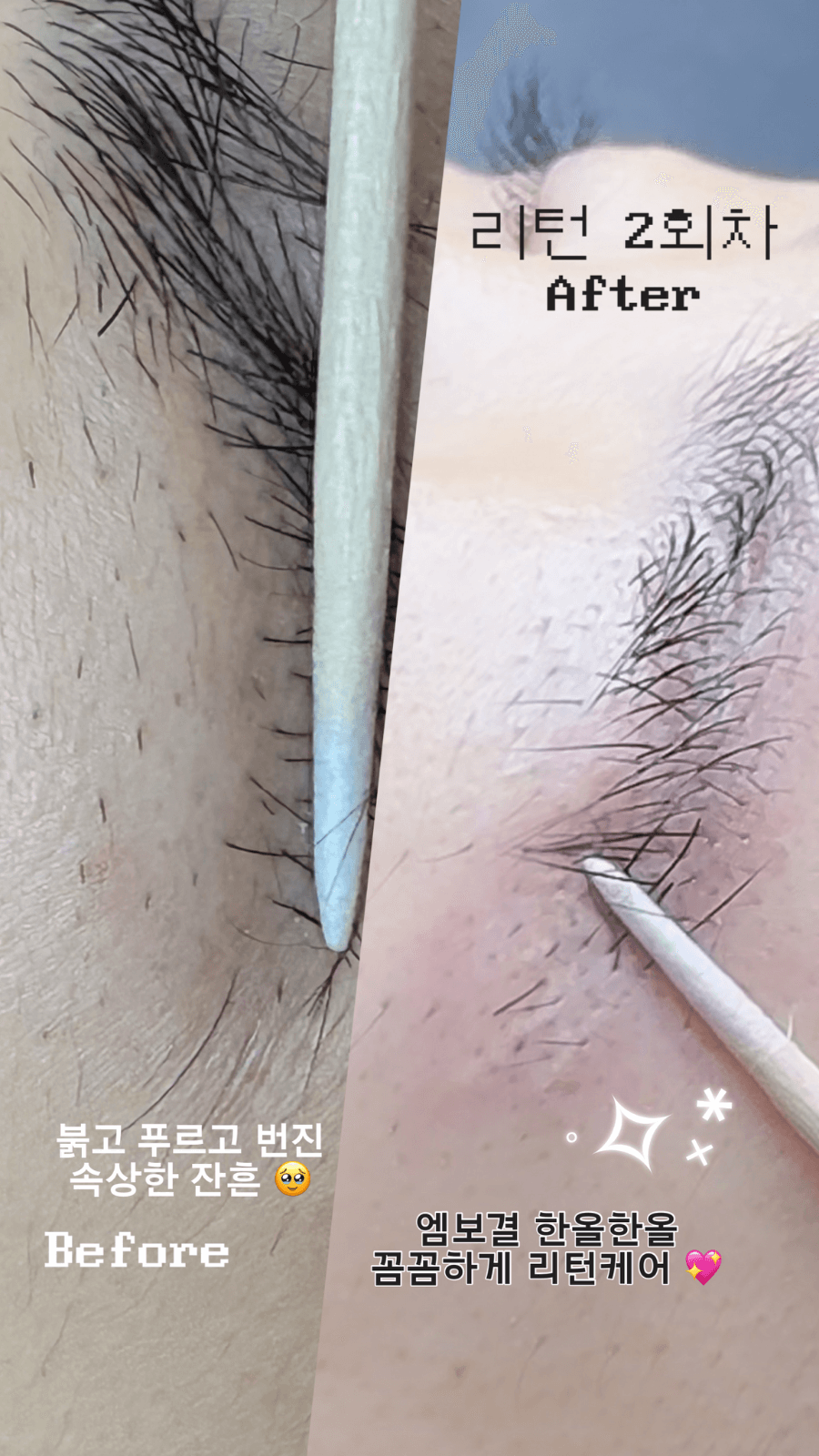 잔흔제거(리턴세럼)